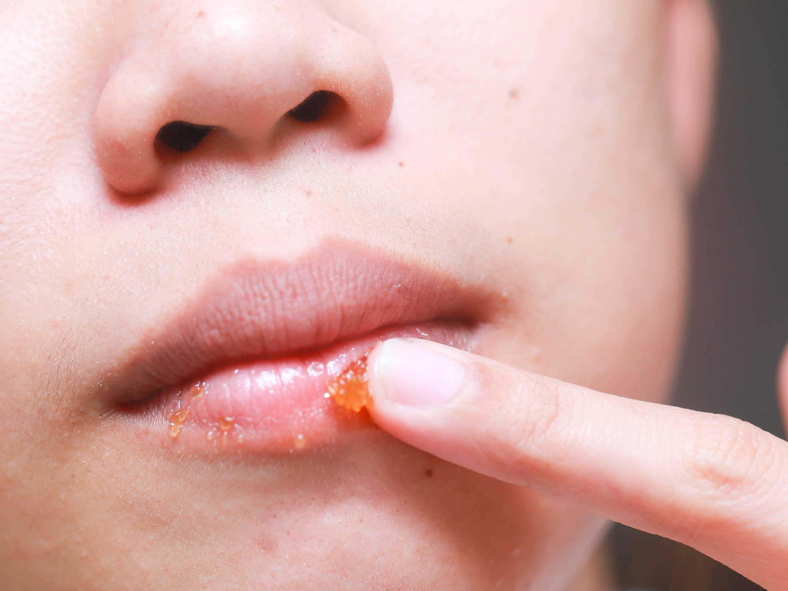 Почему корки в носу – это опасно, и как от них избавиться